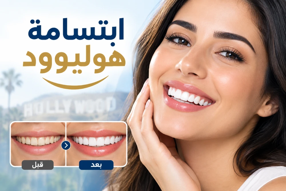 ابتسامة هوليوود وتجميل الأسنان